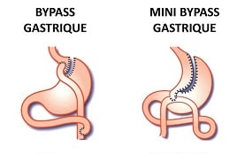 BYPASS-GASTRIQUE-min