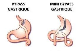 Bypass Gastrique