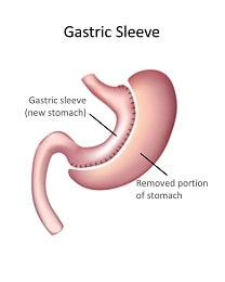 Gastric-Sleeve-in-Tunisia-min