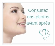 Rhinoplastie avant après-min