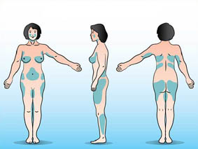 les zones du corps traitées par la liposuccion