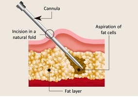 liposuction-min