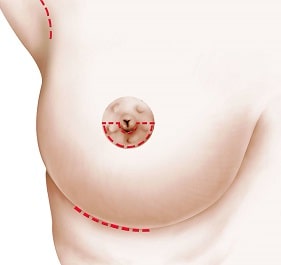 cicatrice-prothèse-mammaire
