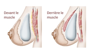 position muscle prothèse mammaire