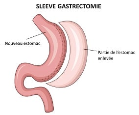 SLEEVE-GASTRECTOMIE-INTERVENTION-min