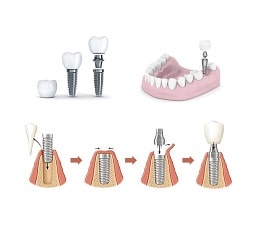 dental-implants-min
