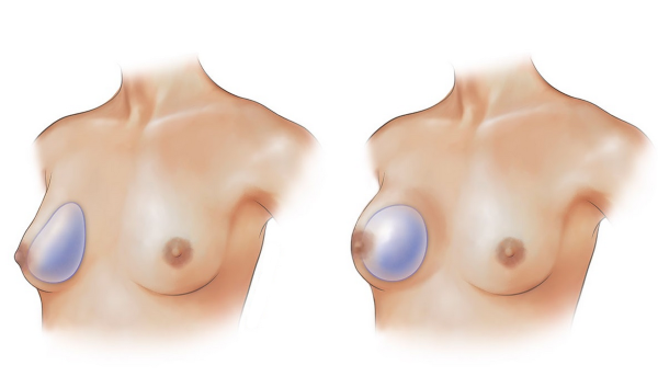 forme prothèse mammaire