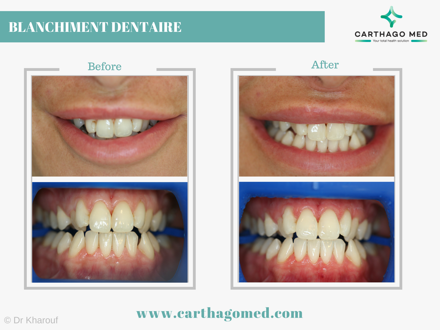 Blanchiment dentaire Tunisie blanchiment dents à prix pas cher
