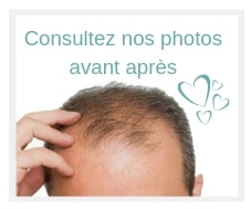 Avant apres greffe de cheveux