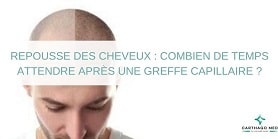 repousse cheveux apres une greffe de cheveux-min