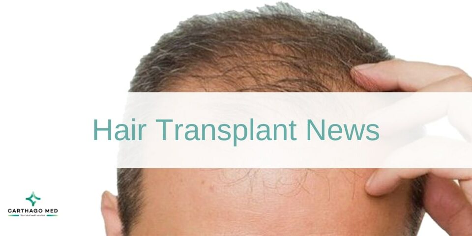 hair transplant