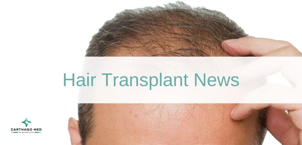 hair transplant