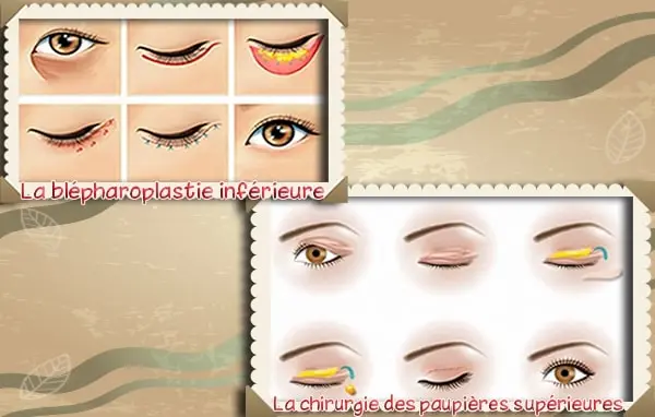 La blépharoplastie