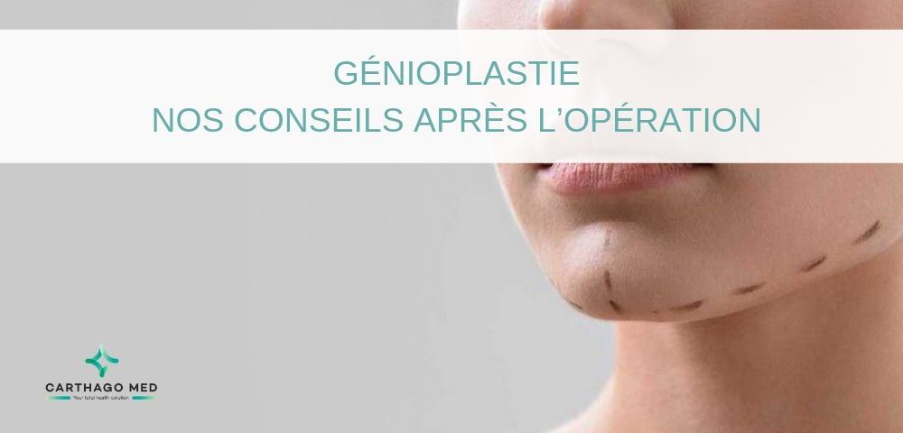 Génioplastie - Carthago Med