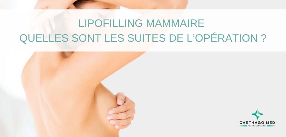 Lipofilling mammaire - Carthago Med