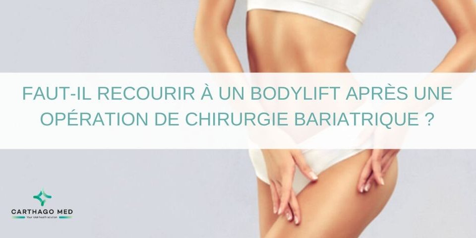 bodylift après une opération de chirurgie bariatrique - Carthago Med