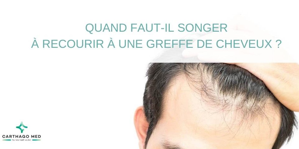 recourir à une greffe de cheveux - Carthago Med