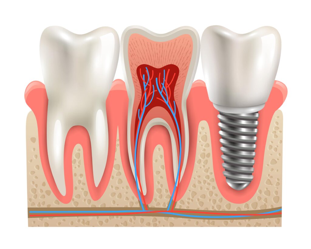 Avantages implant dentaire