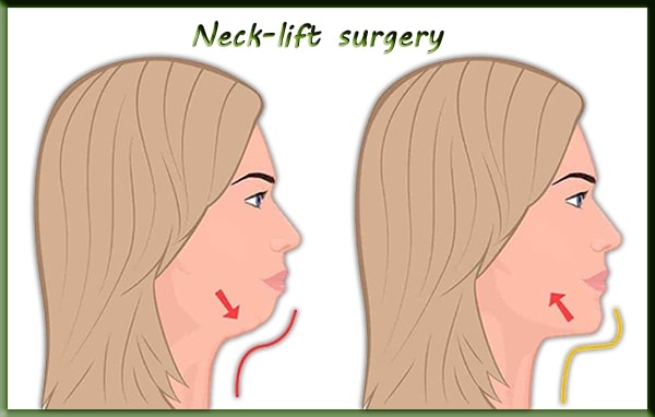 neck-lift surgery