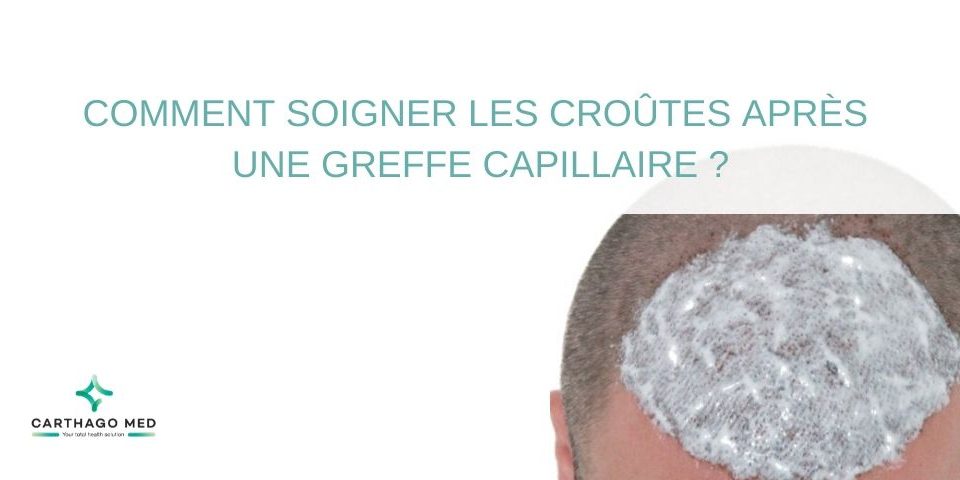 soigner les croûtes après une greffe capillaire - Carthago Med