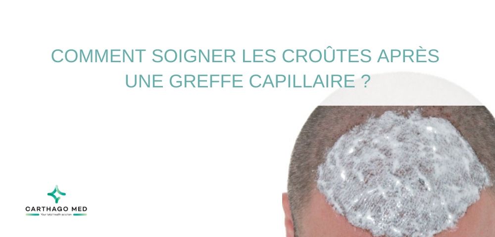 soigner les croûtes après une greffe capillaire - Carthago Med