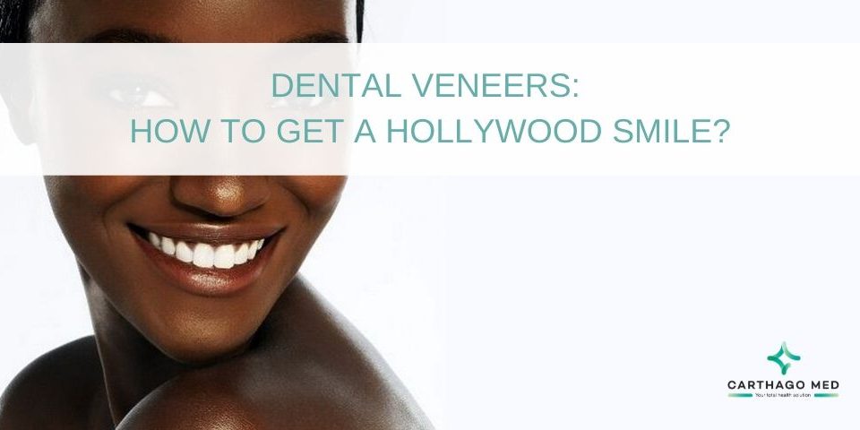 Dental veneers