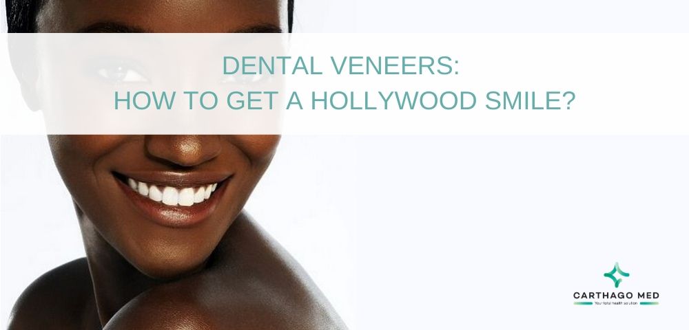 Dental veneers