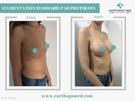 Prothèses mammaires Tunisie Avant Apres (11)