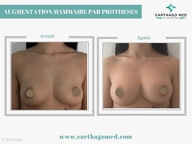 Prothèses mammaires Tunisie Avant Apres