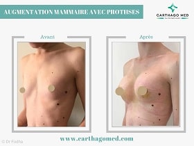 Prothèses mammaires Tunisie Avant Apres (2)