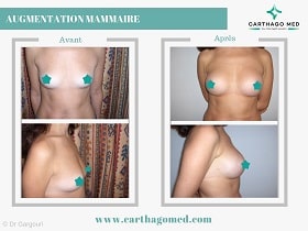 Prothèses mammaires Tunisie Avant Apres (4)