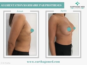Prothèses mammaires Tunisie Avant Apres (7)
