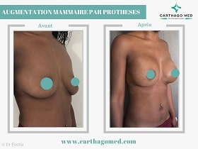Prothèses mammaires Tunisie Avant Apres (8)