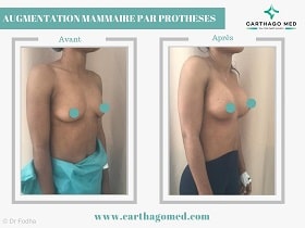 Prothèses mammaires Tunisie Avant Apres (9)