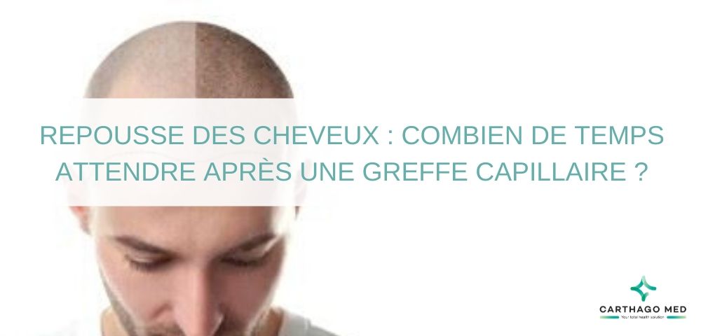 Repousse des cheveux après une greffe capillaire - Carthago Med