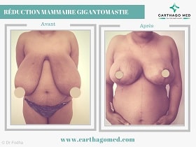 Réduction mammaire Tunisie Avant Apres (1)