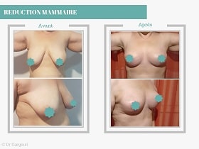 Réduction mammaire Tunisie Avant Apres (2)