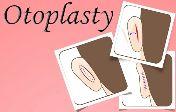 otoplasty