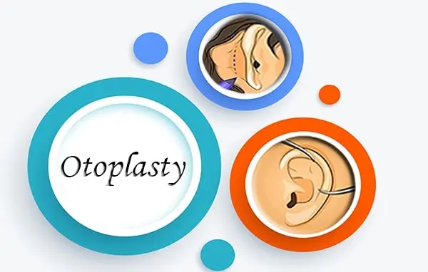 Otoplasty