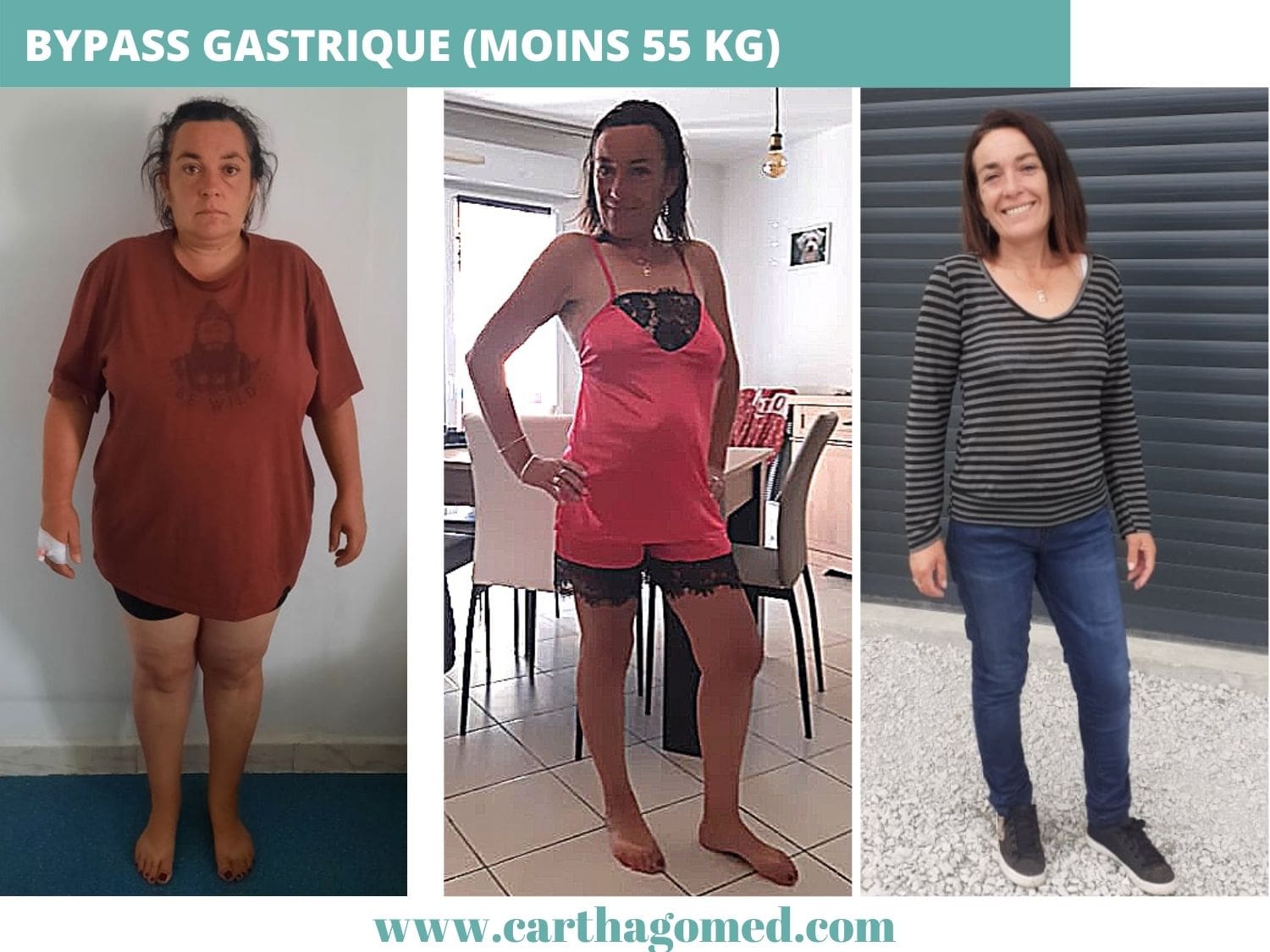 Chirurgie obésité Avant Et Après | CARTHAGO MED