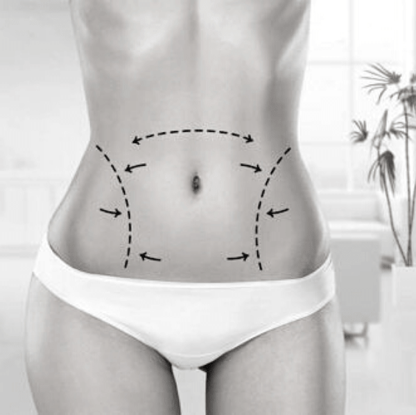 liposuccion-laser-tunisie