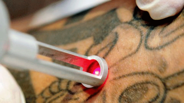 enlever-tatouage-laser-tunisie