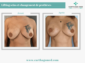 Lifting sein avec changement prothèses mammaires Tunisie Avant Apres