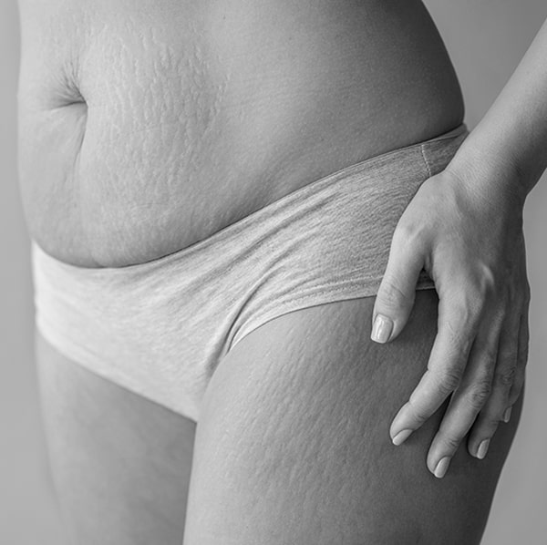 Stretch mark treatment