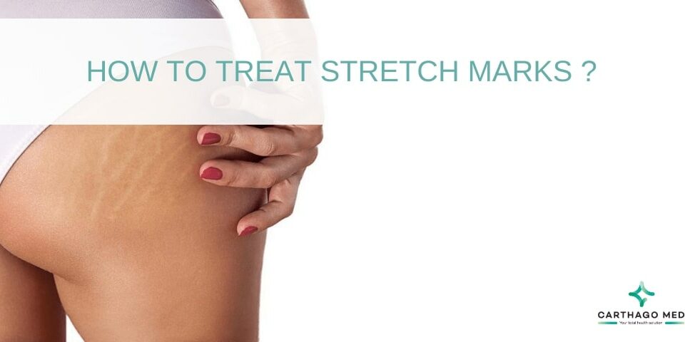 treat stretch marks