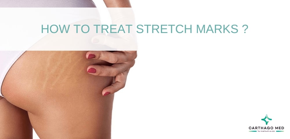 treat stretch marks