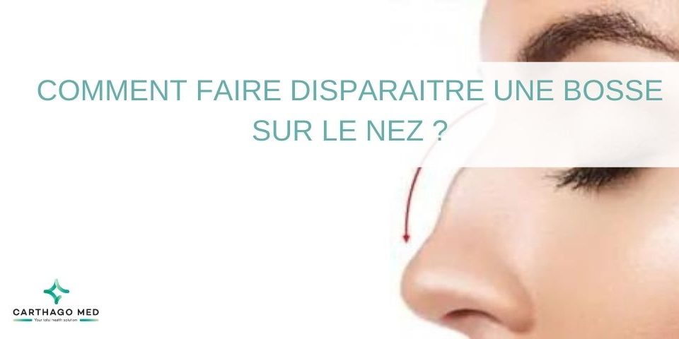 Comment-faire-disparaître-une bosse sur le nez