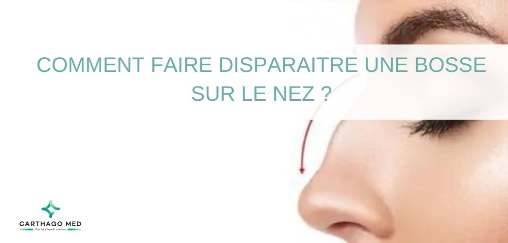 Comment-faire-disparaître-une bosse sur le nez