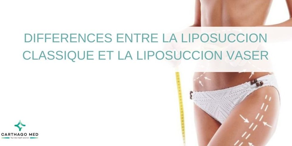 Différences-liposuccion- classique- liposuccion- Vaser-min