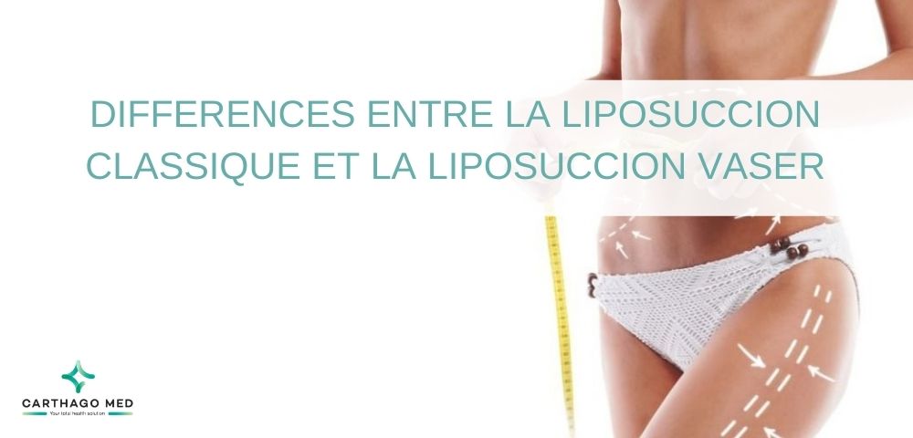 Différences-liposuccion- classique- liposuccion- Vaser-min